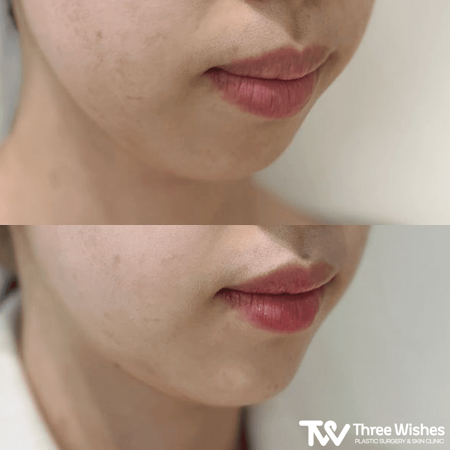 Chin Filler