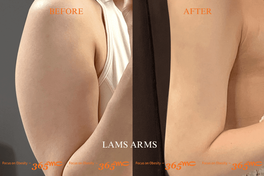 Before and After LAMS