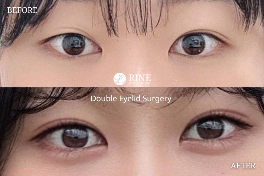 Before and After Double Eyelid Surgery