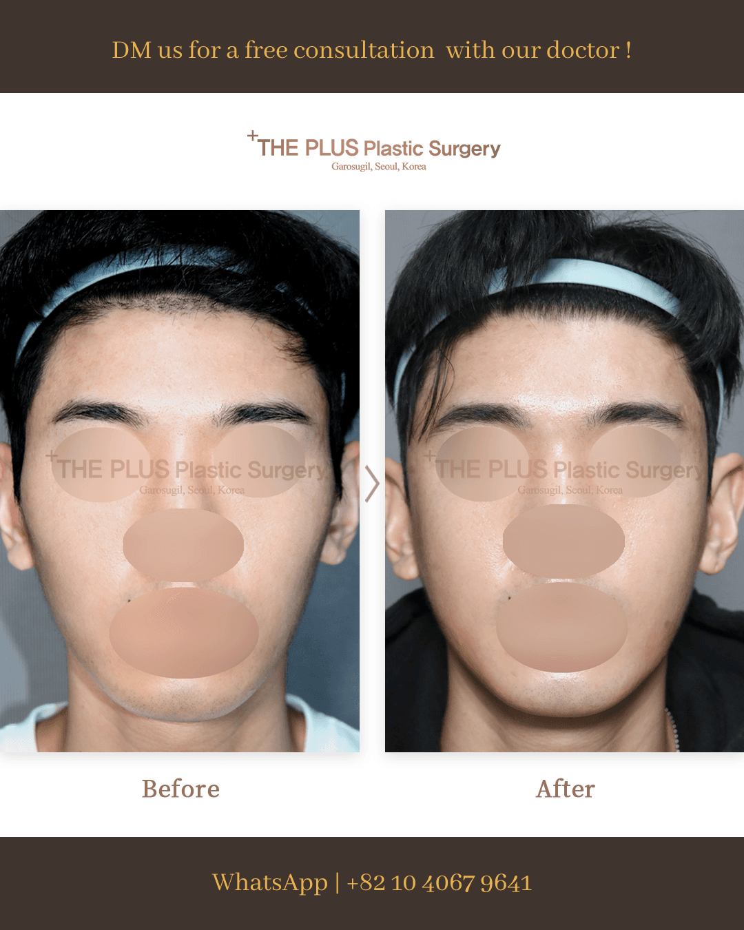 Cheekbone Reduction