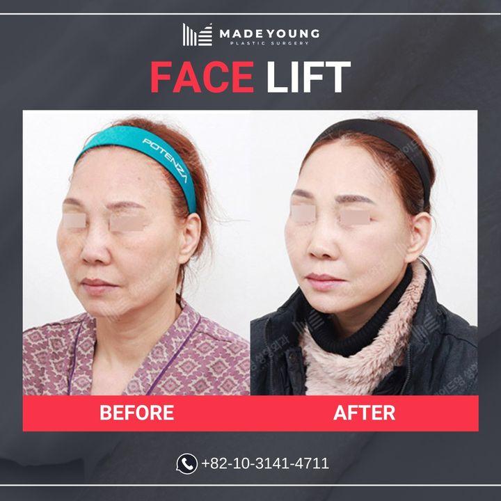 Rediscover your youth with a MadeYoung Face Lift. These before and after shots capture the remarkable transformation and rejuvenation.
