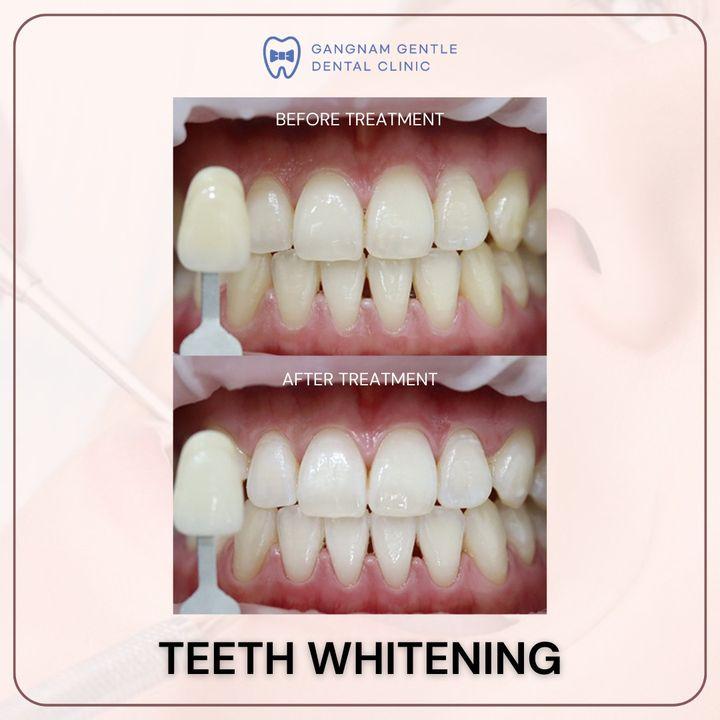 Brighten your smile with our professional teeth whitening services. See the clear difference in our before and after photos.