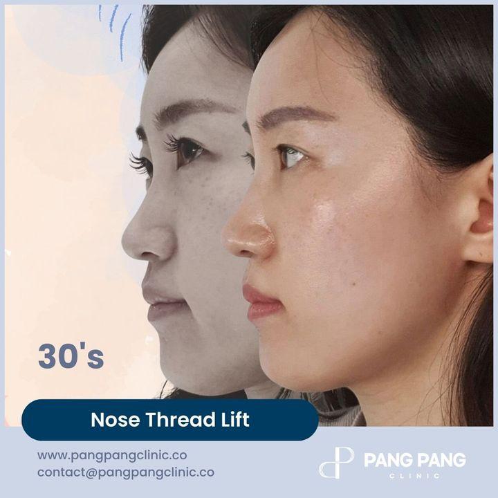 Unveil the Secret to a Refined Profile: Our Nose Thread Lift Treatment at PangPang Clinic ✨ Are you seeking a subtle yet impactful enhancement for your facial features? Discover the transformative power of our Nose Thread Lift procedure at PangPang Clinic. Our specialized technique offers a non-surgical solution to redefine and sculpt your nose, creating a more defined and harmonious profile.