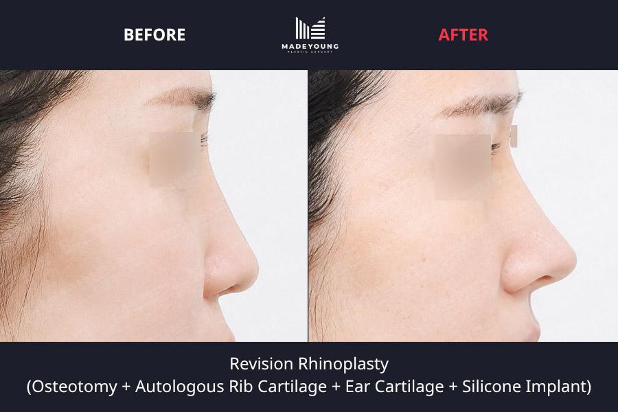 Rhinoplasty osteotomy autologous rib cartilage ear cartilage silicone implant