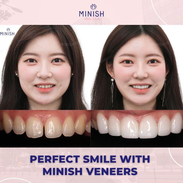 Minish veneers creating stunning before and after transformations. Let us help you achieve the smile you've always wanted.