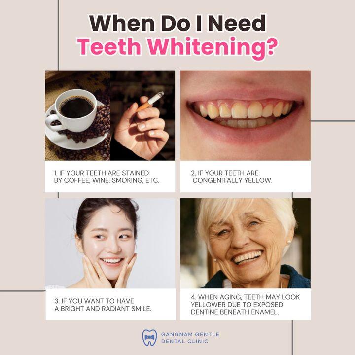 Teeth Whitening
