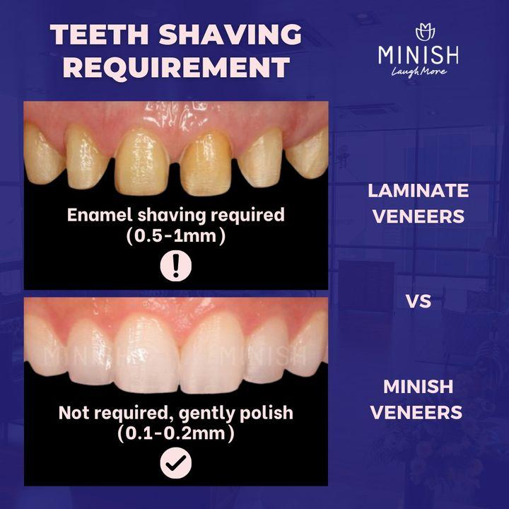 Veneers, All-ceramic Veneers