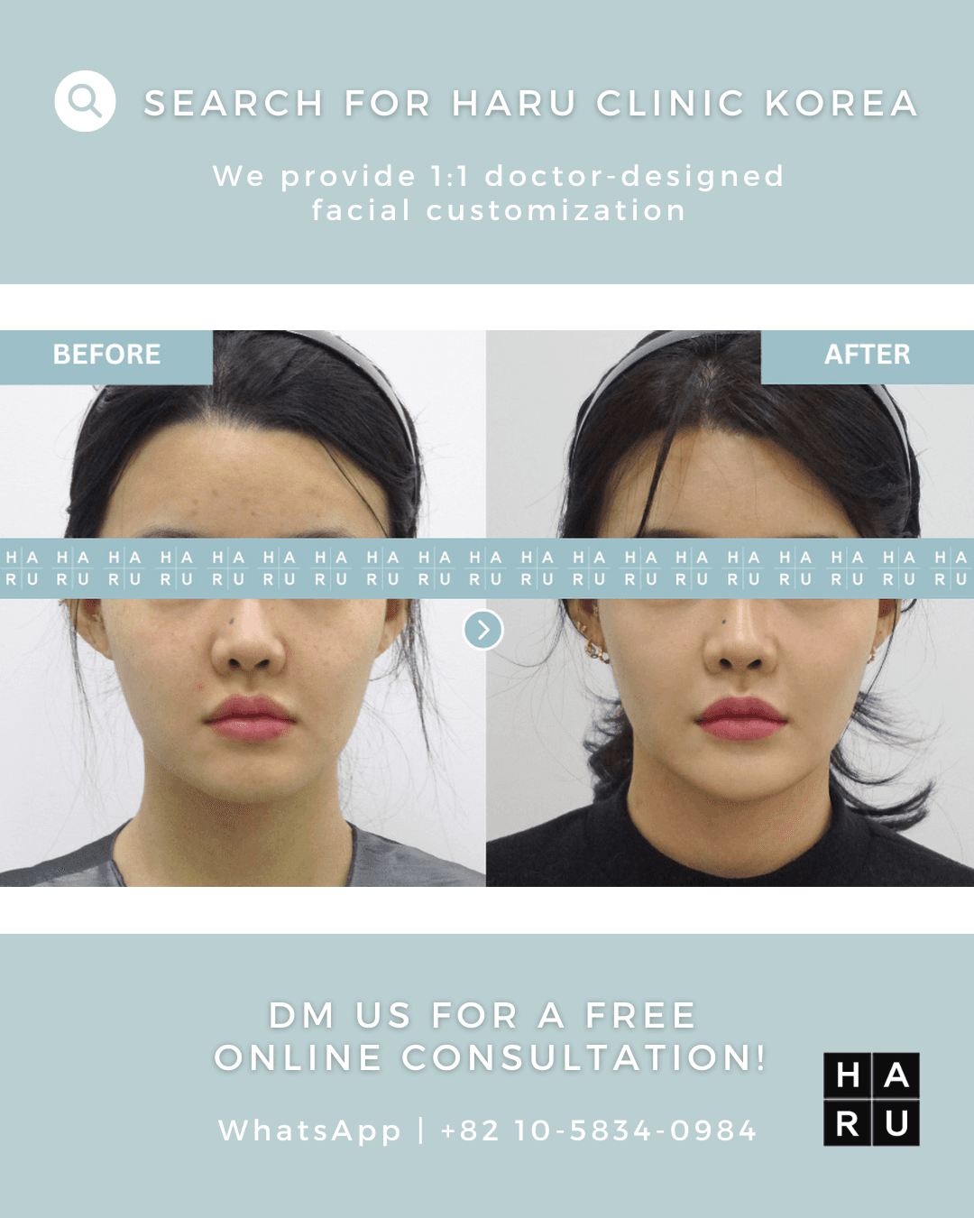 Chin Filler, Chin Botox, Fat Dissolving Injection