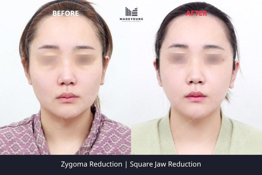 Before and After Cheekbone Reduction
