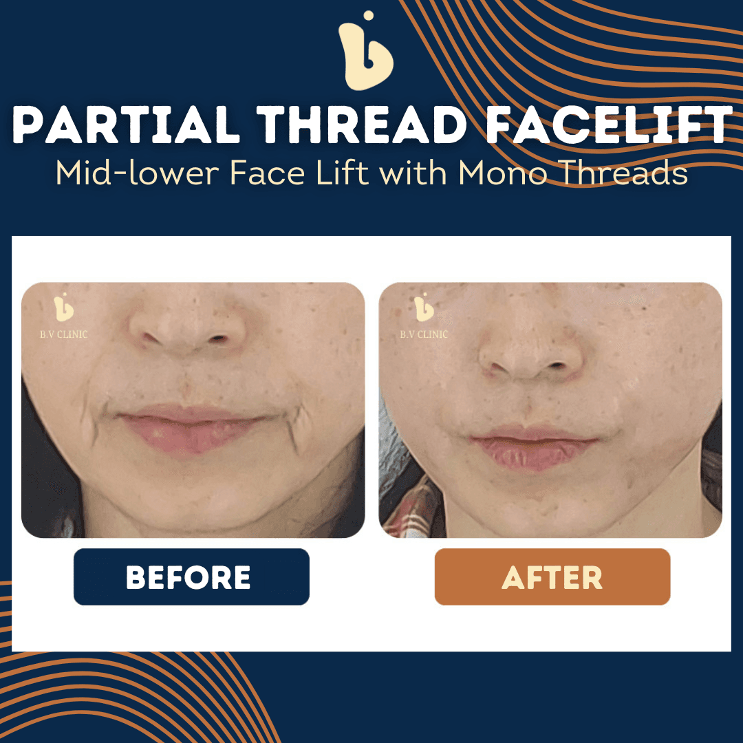 B.V Clinic before and after image