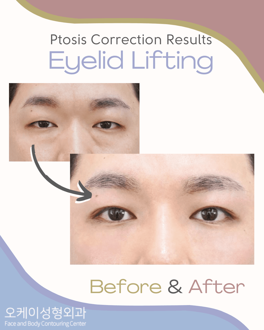 Ptosis Correction