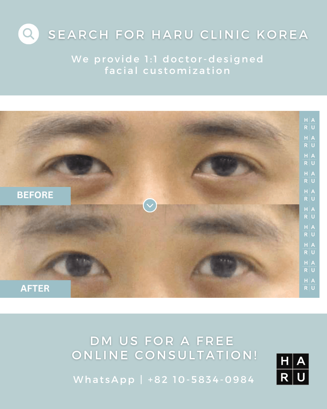 Forehead Thread Lift, Eye Thread Lift