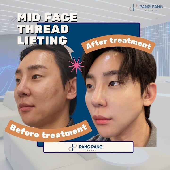 loss of facial volume korea