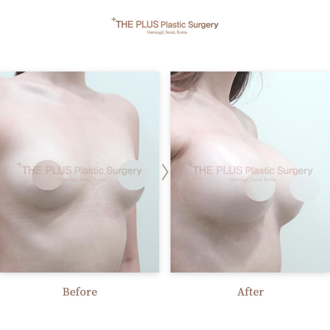 Breast Implant Motiva 300cc with Armpit Incision Method