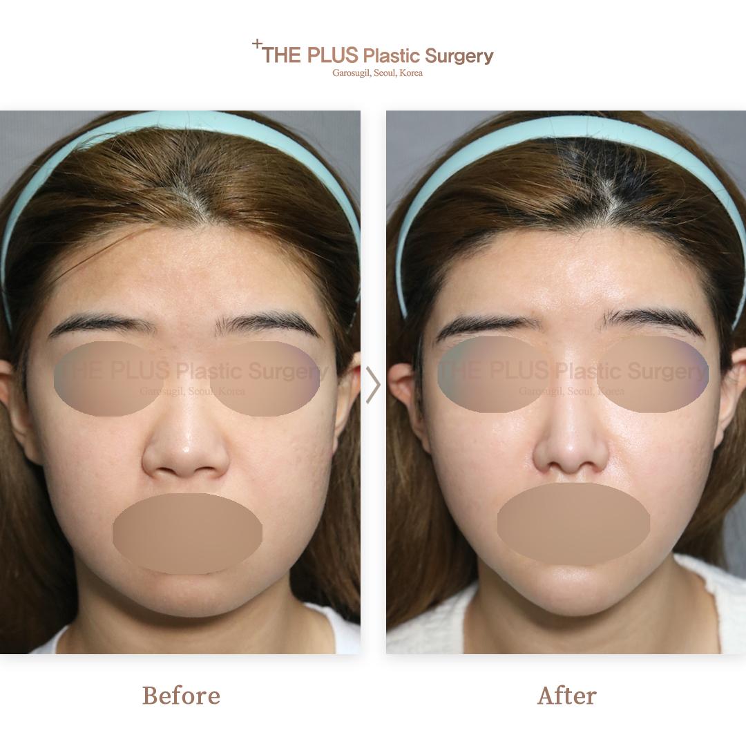 Chin Implant & Face Fat Grafting