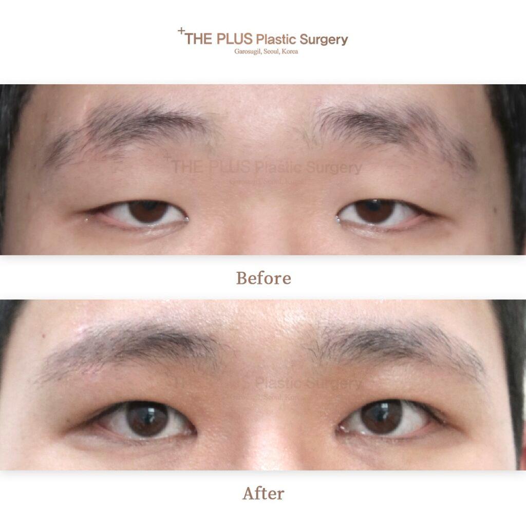 Ptosis Correction