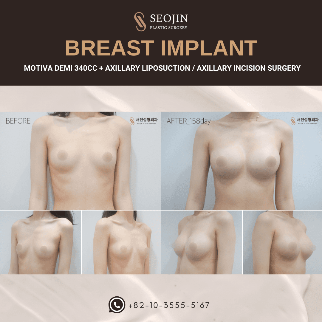 breast surgery korea