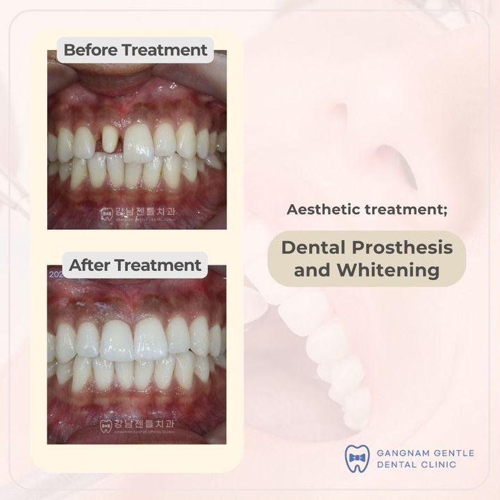 cost dental bridge korea