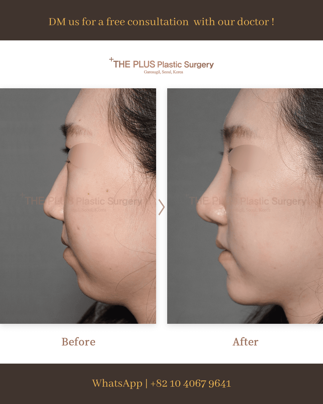 Chin Surgery