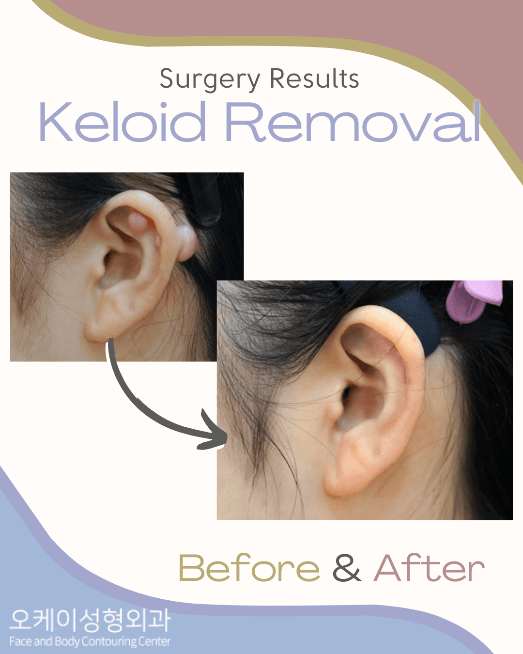 cost keloid removal korea