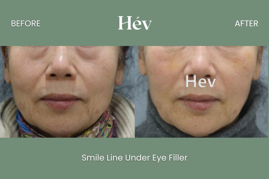 Smile Line Under Eye Filler