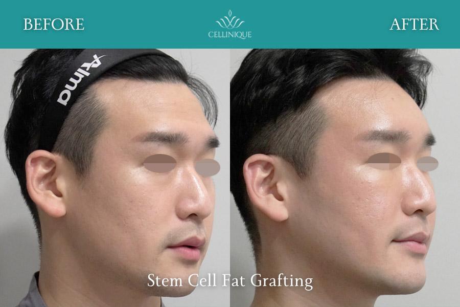 Before and After Stem Cell Fat Grafting