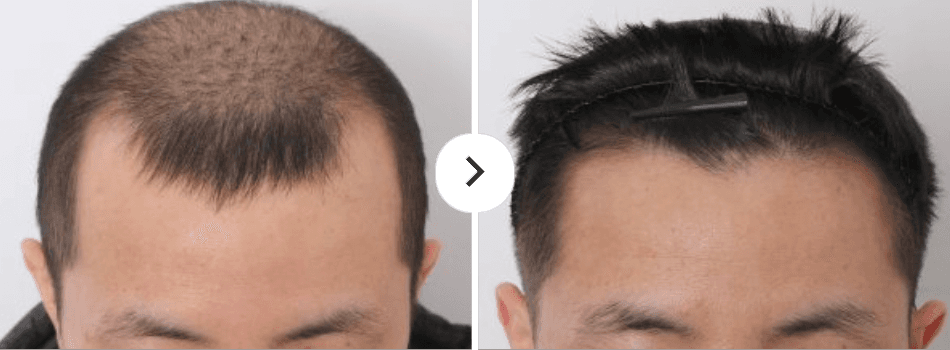 Before and After Hair Loss Treatment