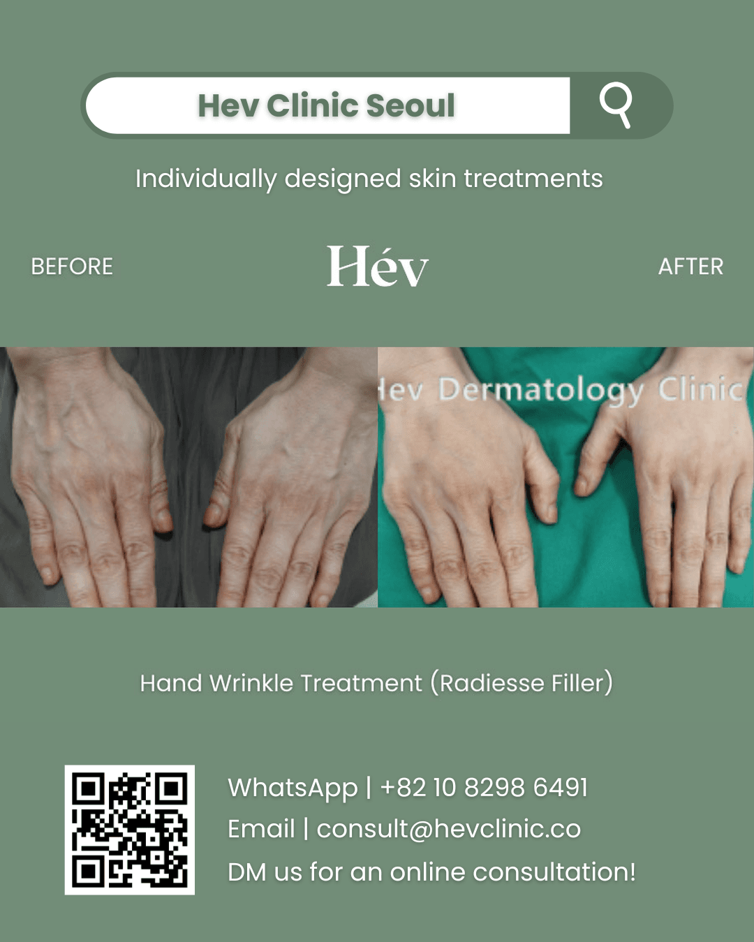 Hand Wrinkle Treatment, Radiesse Filler