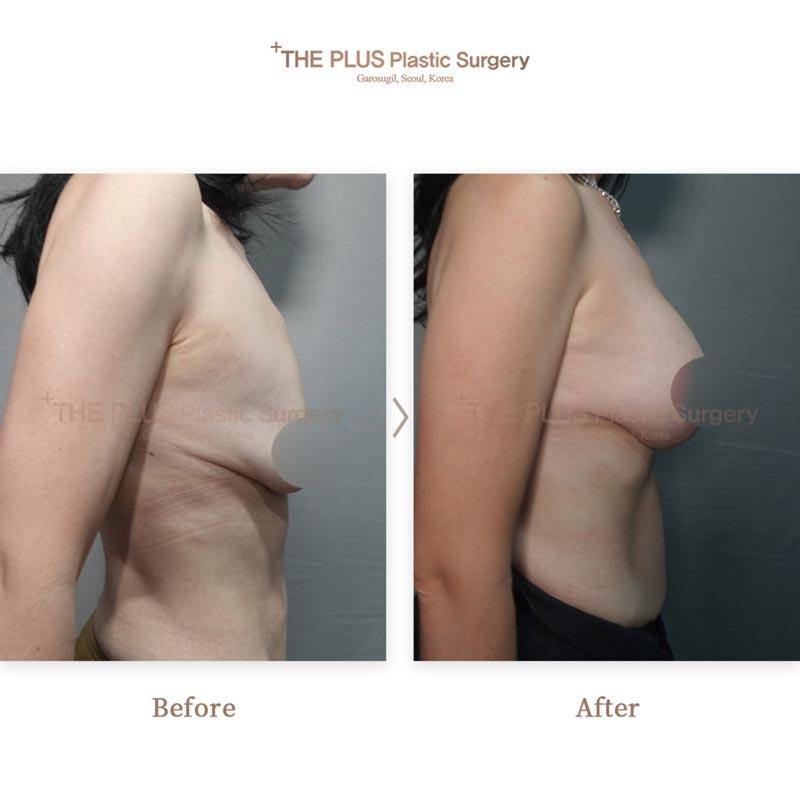 Breast Lifting + Breast Implants