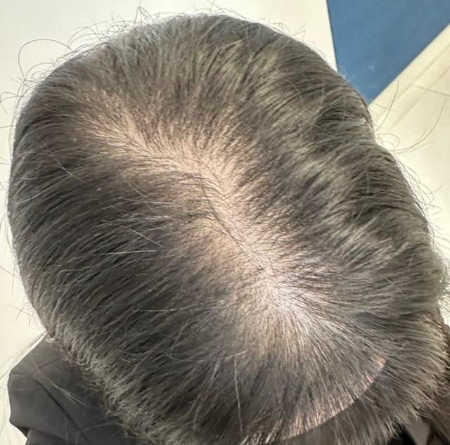 Before Hair Loss Treatment