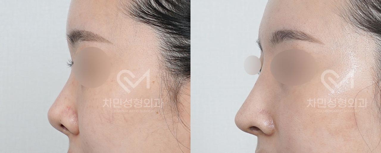Before and After Rhinoplasty