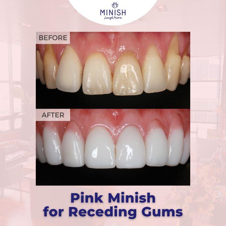 cosmetic tooth reshaping korea