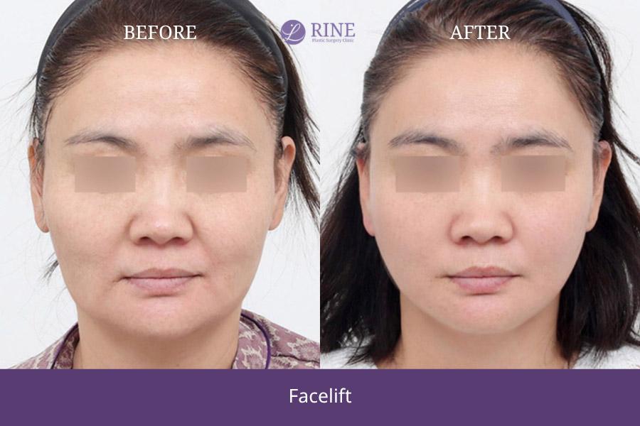 SMAS Facelift