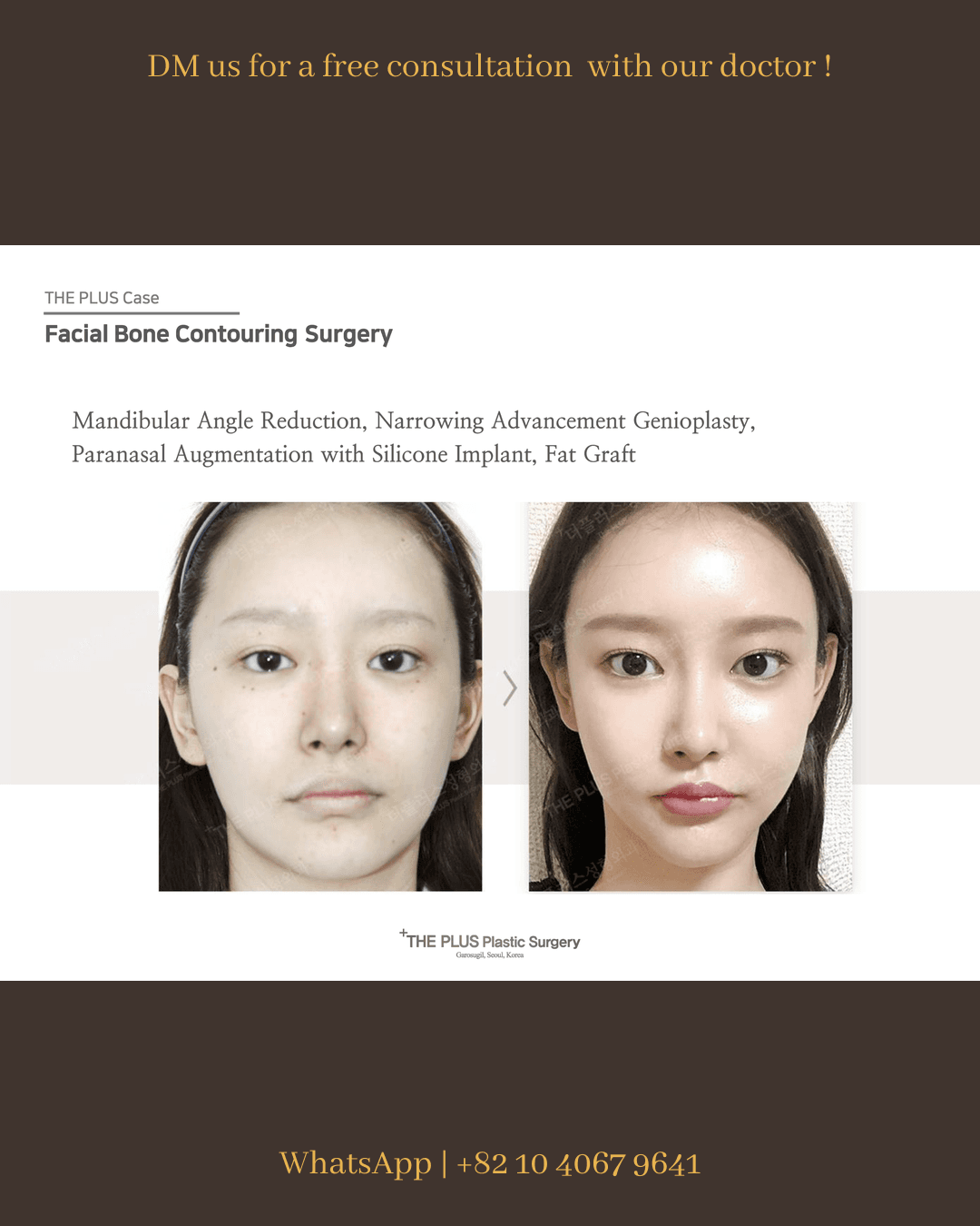 Face Contouring, Face Fat Grafting, Square Jaw Surgery, Cheekbone Reduction, Paranasal Implant