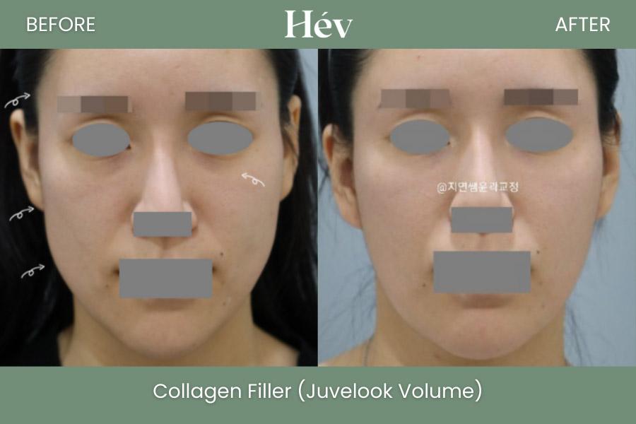 Juvelook Volumen-Kollagenfiller