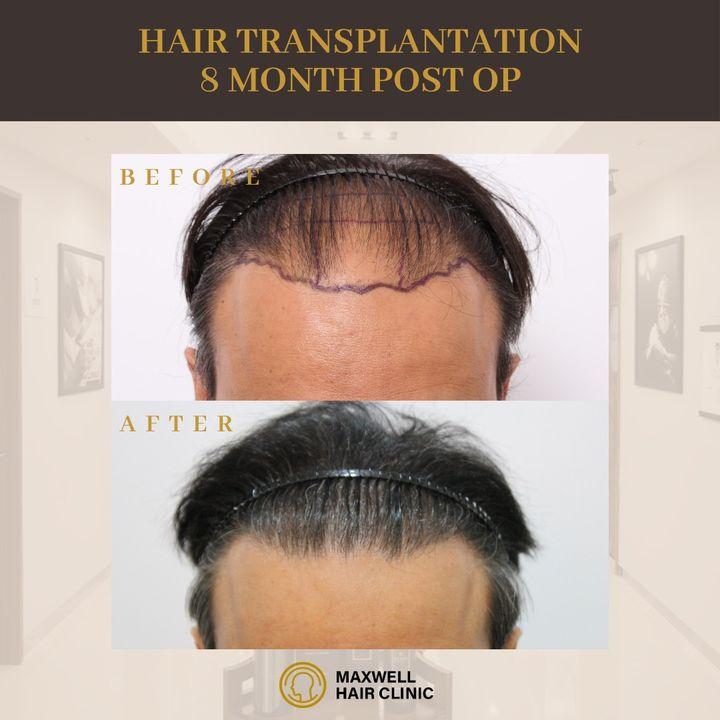 hair loss vs hair transplant korea