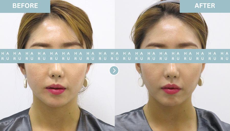 Lip Line Correction