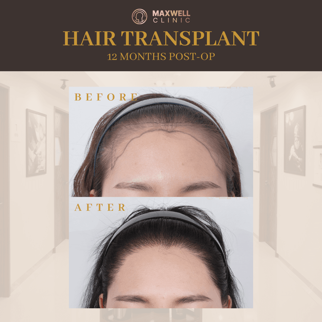 cost of hair transplant in korea