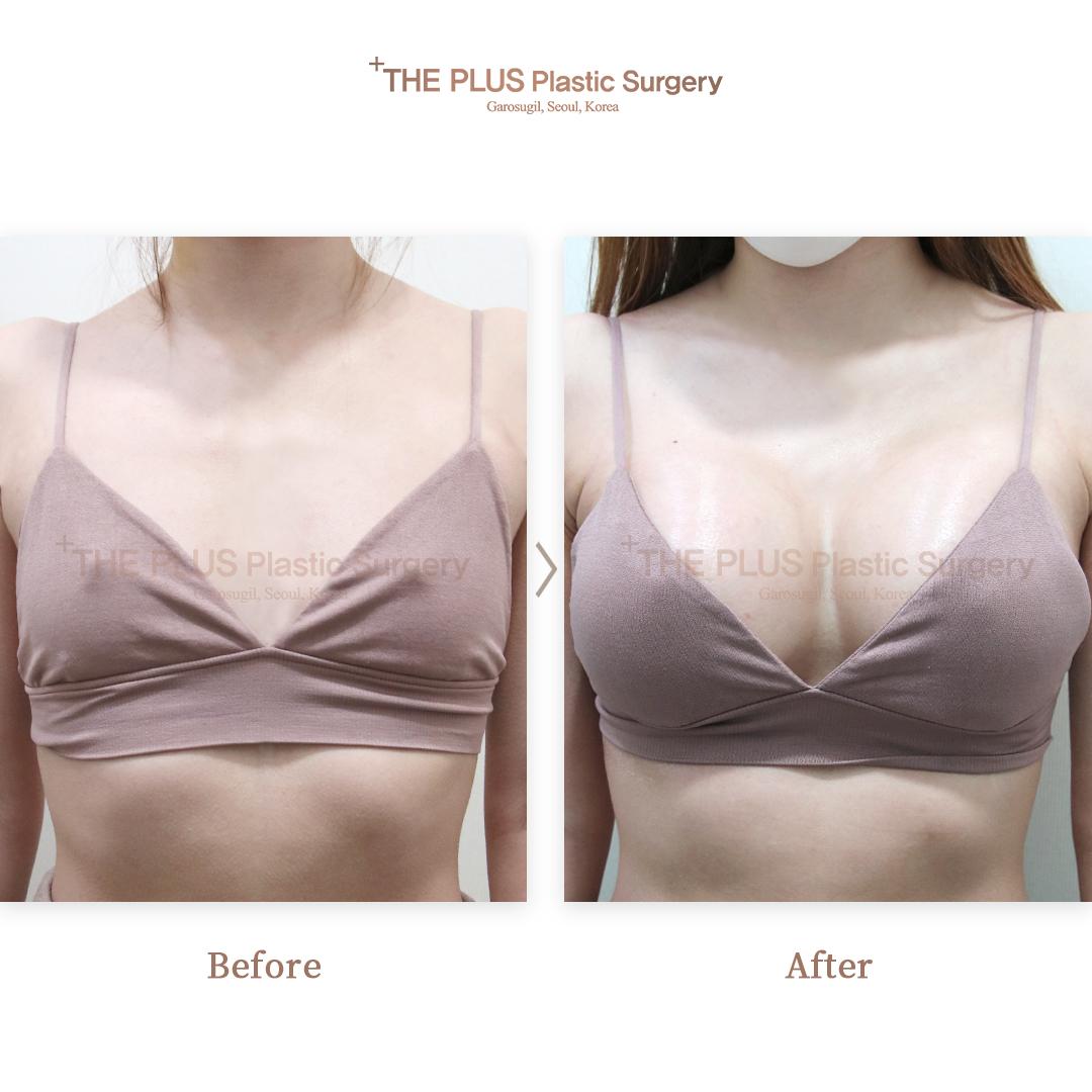 Breast Implant Motiva 400cc and Axillary Liposuction