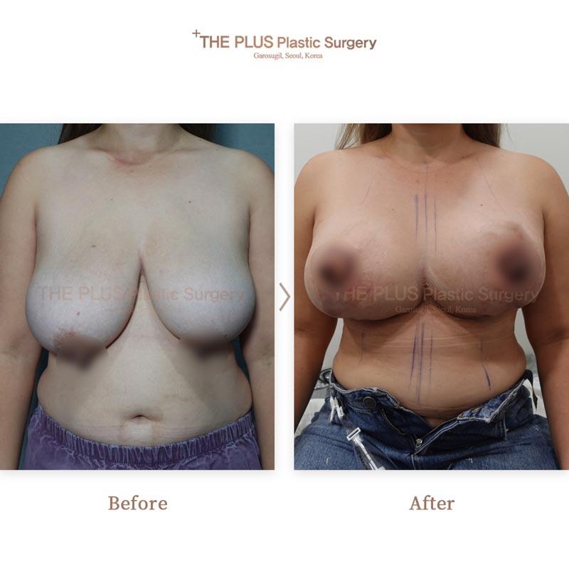 Breast Reduction with areola reduction