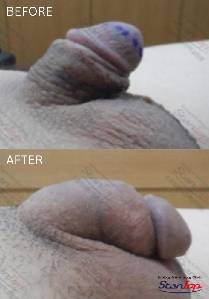 Stantop Penis Lengthening