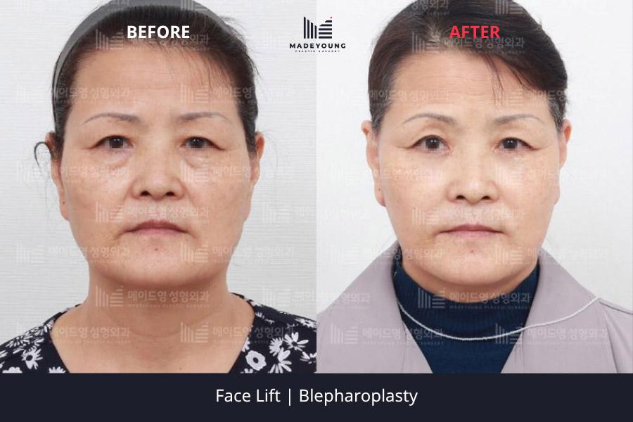 Made Young Plastic Surgery before and after image