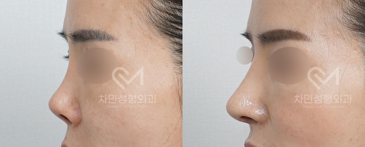 Before and After Rhinoplasty