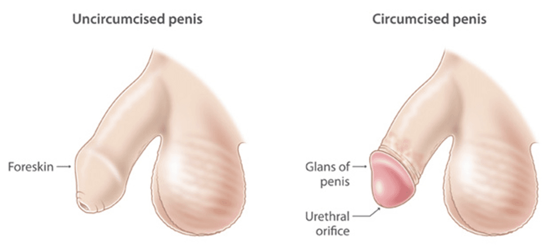 Circumcision