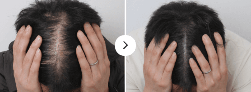 Before and After Hair Loss Treatment