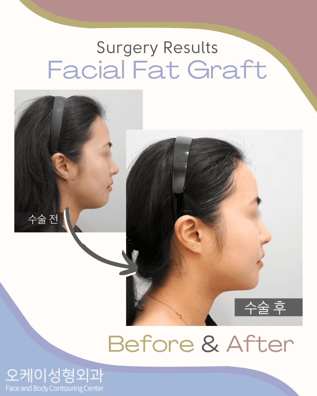 full face fat grafting in korea