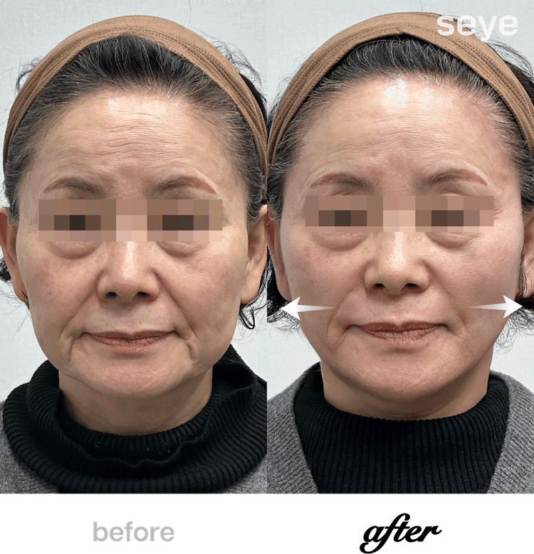 Before and After Thread Lift
