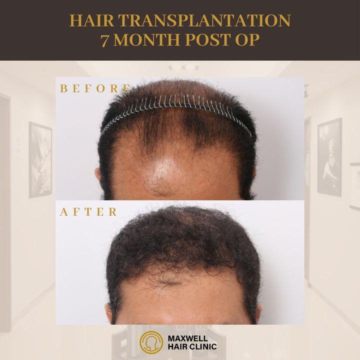 cost of hair transplant in korea