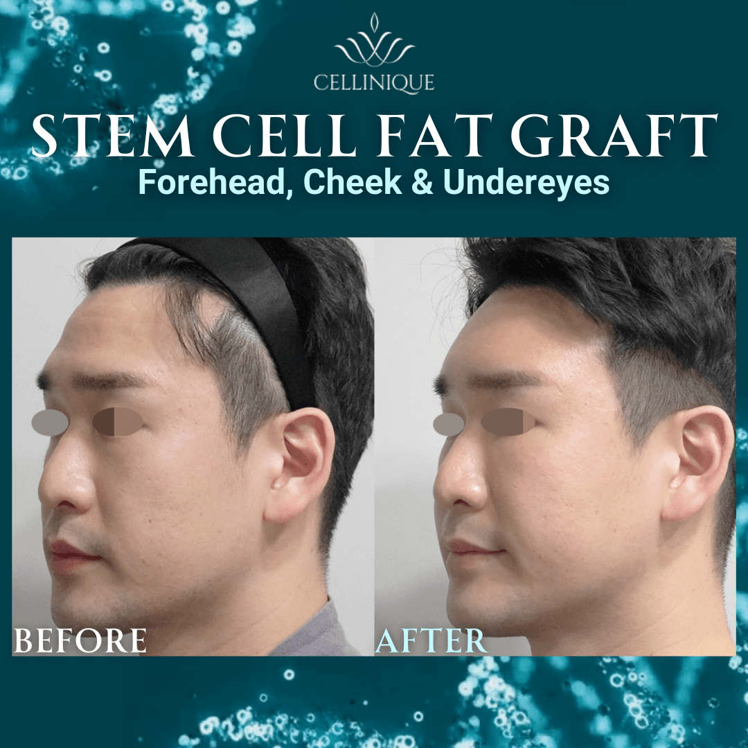 Cellinique Clinic before and after image