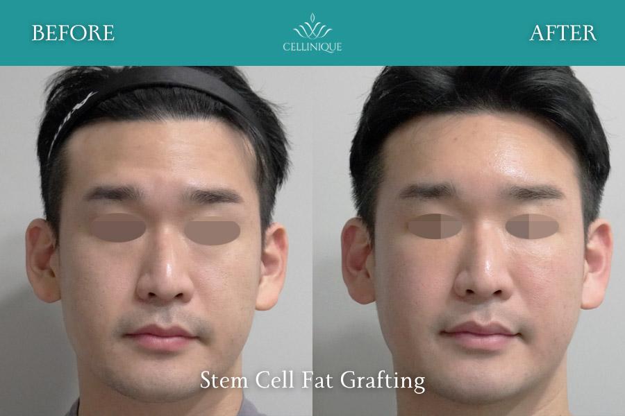 Cellinique Clinic before and after image